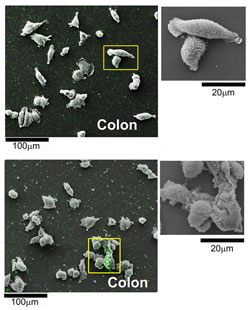 Two pictures showing the difference of non-treated cancer cells and ones that are treated with nanoparticles