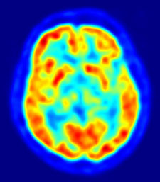 PET-scan of the brain