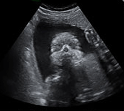 Ultralyd scan billede af foster