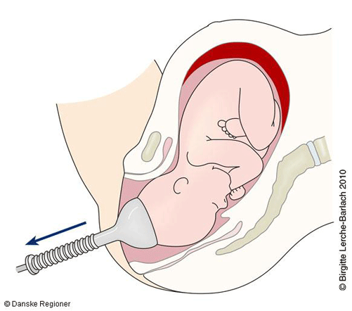 Svupper bruges til at hjælpe med fødsel