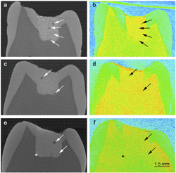 Images of teeth taken with x-ray and neutron scattering