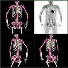 PET-scanning af, hvordan sukkervand bliver optaget i musklerne