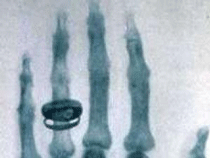 Røntgenbillede af hånd
